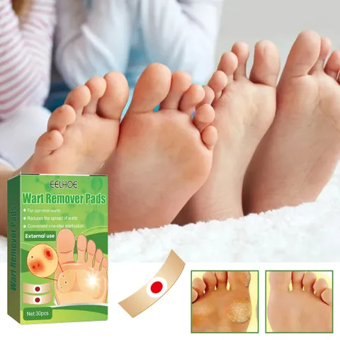 Miếng dán plasters (Hộp 30 miếng Plaster - Tem chống hàng giả) Xử lý Mụn cóc, Mắt cá chân, Vết chai, Cồi cá, Mụn hạt