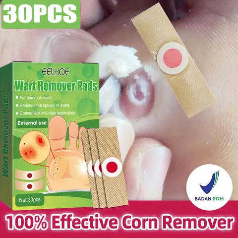 Miếng dán plasters (Hộp 30 miếng Plaster - Tem chống hàng giả) Xử lý Mụn cóc, Mắt cá chân, Vết chai, Cồi cá, Mụn hạt