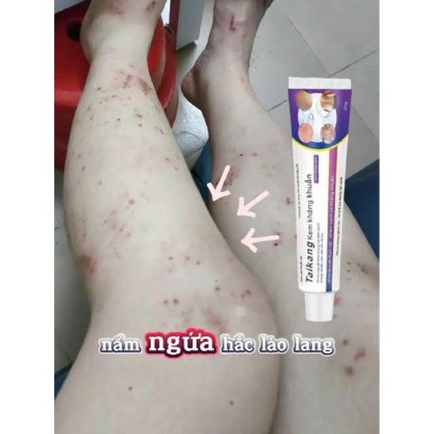 Bán chạy WJG kem Giảm ngứa do muỗi đốt hỗ trợ cải thiện các vấn đề da