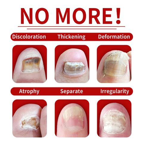 Nấm móng tay Loại bỏ nguyên nhân gốc rễ của nấm Sửa chữaa móng tay bị hư hỏng
