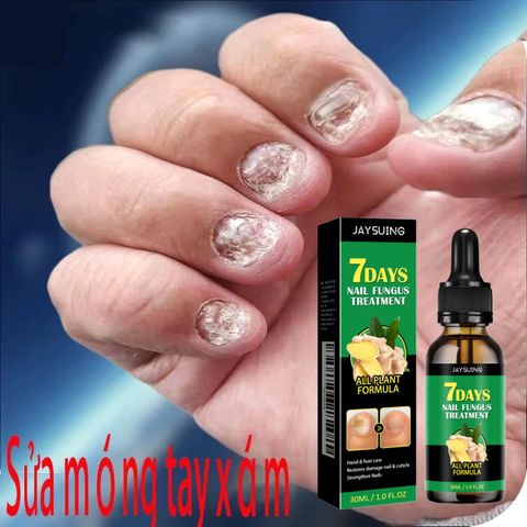 Nấm móng tay Loại bỏ nguyên nhân gốc rễ của nấm Sửa chữaa móng tay bị hư hỏng