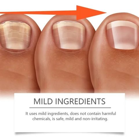 Tinh chất Dưỡng móng tay dài cứng Nails Repair Serum cứng móng, phục hồi móng Mỏng, Chẻ, Serum Nấm Móng 50ML