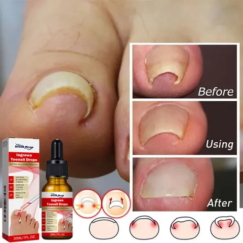 Serum nấm móng tay chân dưỡng cứng dài móng 