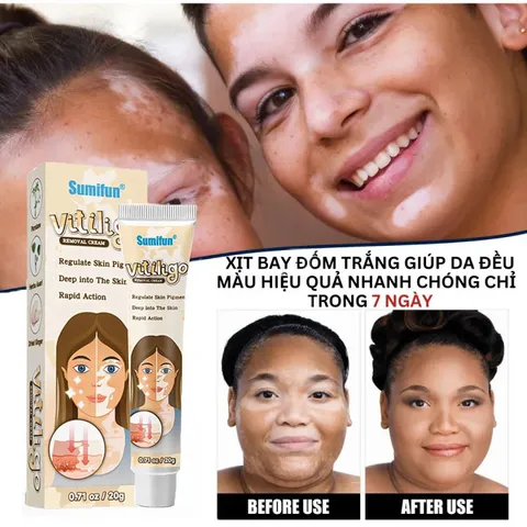 Kem đốm trắng Vitiligo removal cream kem làm sạch bạch biến chăm sóc da làm giảm các đốm trắng trên