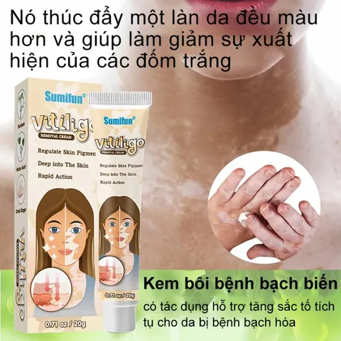 Kem đốm trắng Vitiligo removal cream kem làm sạch bạch biến chăm sóc da làm giảm các đốm trắng trên