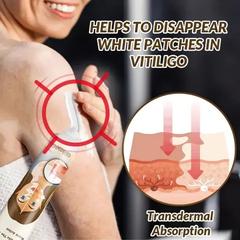 Kem đốm trắng Vitiligo removal cream kem làm sạch bạch biến chăm sóc da làm giảm các đốm trắng trên