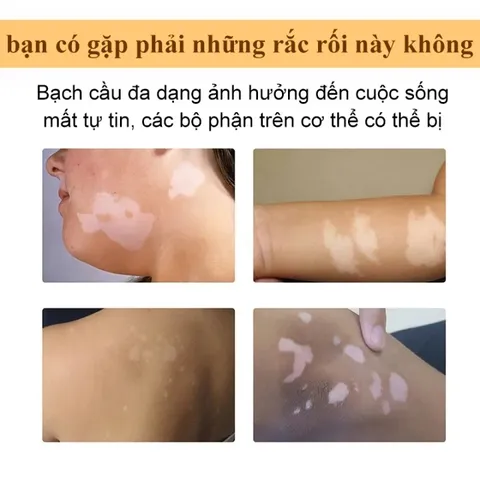 Kem đốm trắng Vitiligo removal cream kem làm sạch bạch biến chăm sóc da làm giảm các đốm trắng trên