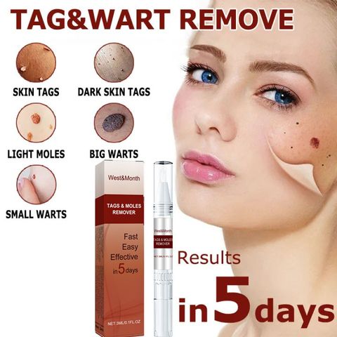 Gel thảoo dượcc: xoá nốt ruồi, mụn cóc, tàn nhang, mụn thịt – Lành tính, không đau, ngừa sẹo lồi ，Tiện lợi sử dụng tại nhà