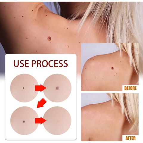 Gel thảoo dượcc: xoá nốt ruồi, mụn cóc, tàn nhang, mụn thịt – Lành tính, không đau, ngừa sẹo lồi ，Tiện lợi sử dụng tại nhà