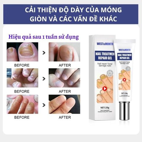 Kem nấm móng móng tay chăm sóc Nấm móng tay 20g Cải thiện vết nứt móng tay giảm nhiễm nấm kích thích mọc
