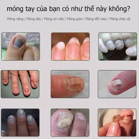 Kem nấm móng móng tay chăm sóc Nấm móng tay 20g Cải thiện vết nứt móng tay giảm nhiễm nấm kích thích mọc