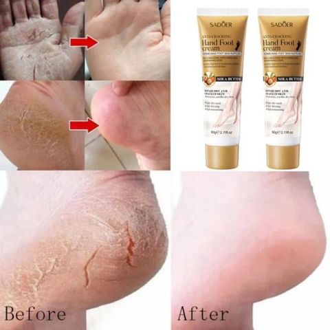 Kem dưỡng chân Kem dưỡng da tay Kem Chống Nẻ 60g Dưỡng Ẩm Chống Nẻ Da Tay Chân á sừng Bong da Nứt Gót Chân