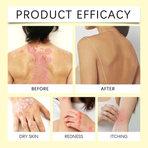 Xịt Giảm Ngứa giảm ngứa tức thì, viêm da cơ địa, nấm, ngứa... hiệu quả