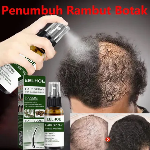 Xịt Mọc Tóc , Giảm Rụng Tóc Và Kích Thích Mọc Tóc