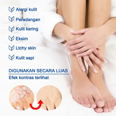 Kem hỗ trợ giảm ngứa do nấm, viêm da cơ địa, hắc lào, tổ đỉa, vẩy nến, á sừng, lang ben