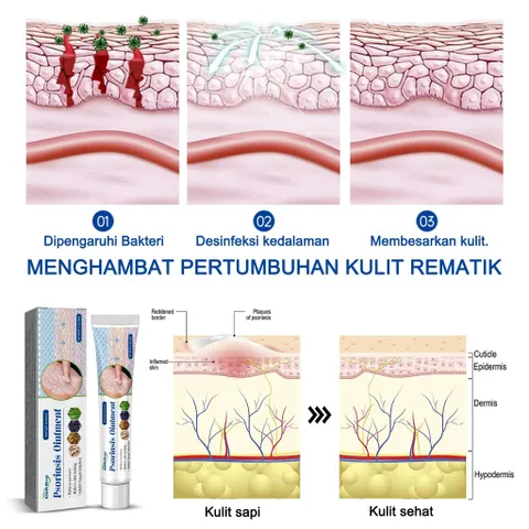 Kem hỗ trợ giảm ngứa do nấm, viêm da cơ địa, hắc lào, tổ đỉa, vẩy nến, á sừng, lang ben