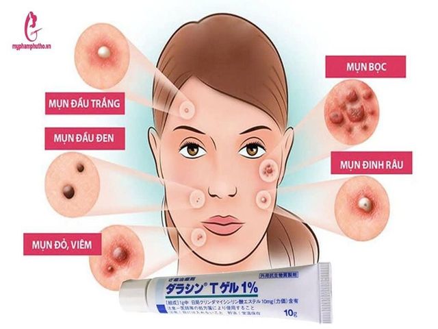 Kem Giảm Mụn Dalacinn T Gel 1% Sato Nhật Bản 10gr - Hỗ Trợ Làm Sạch Da, Ngăn Ngừa Tái Phát Mụn, Giảm Viêm Đỏ, Dưỡng Ẩm Da