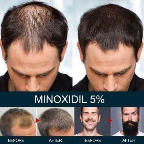 Xịt mọc tóc Minoxidil 5% BAILLEUL - Giảm rụng tóc, kích thích mọc tóc hiệu quả cho nam và nữ - Best Seller Pháp