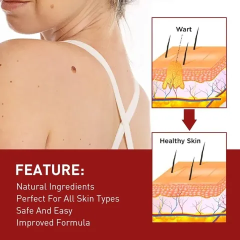 [Loại Xịn]Tẩy nốt ruồi mụn cóc, mụn thịt, dưỡng da, kháng khuẩn, tinh chất thảoo dượcc thiên nhiên, ann toànn