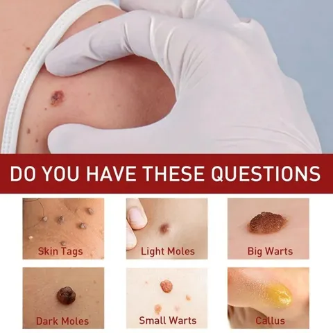 [Loại Xịn]Tẩy nốt ruồi mụn cóc, mụn thịt, dưỡng da, kháng khuẩn, tinh chất thảoo dượcc thiên nhiên, ann toànn