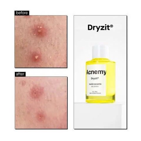 Tinh Chất Chấm Mụn Acnemy Dryzit Spot Drying Lotion 30ml Thương hiệu từ Tây Ban Nha