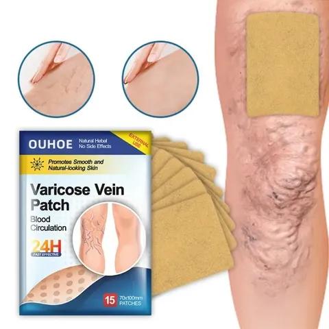 Giãn tĩnh mạch Miếng dán giảm giãn tĩnh mạch giảm mỏi phù nề tê chân giảm nổi gân xanh trên da