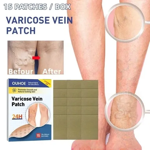 Giãn tĩnh mạch Miếng dán giảm giãn tĩnh mạch giảm mỏi phù nề tê chân giảm nổi gân xanh trên da