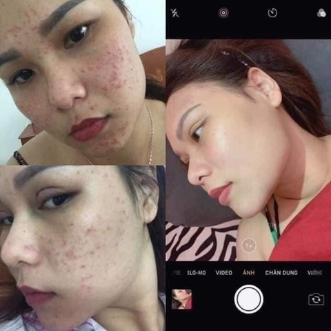 (Hàng Chuẩn) Kem Mụn Rau Má Dr.Skinacne 15g Sạch mụn, Xóa thâm, Trắng da Chính hãng