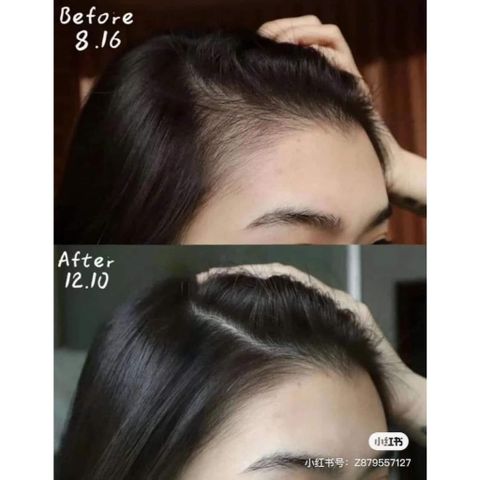 Xịt Minoxidil giảm rụng tóc,giúp tóc chắc khỏe
