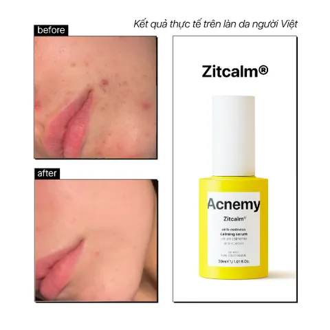 Huyết Thanh ACNEMY ZITCALM SERUM 30ml Dưỡng Ẩm Phục Hồi  Da