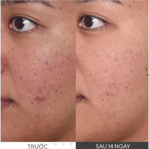 Tinh Chất Làm Mờ Thâm Nám Murad Rapid Dark Spot Correcting Serum 5ml