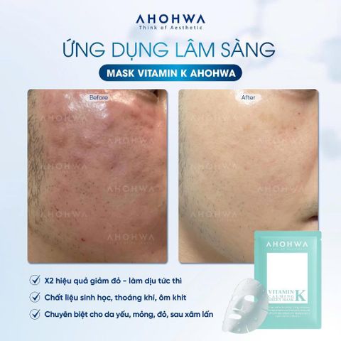 Mặt Nạ Vitamin K Ahohwa - Sheet Mask - Mặt nạ cấp ẩm phục hồi sinh học 