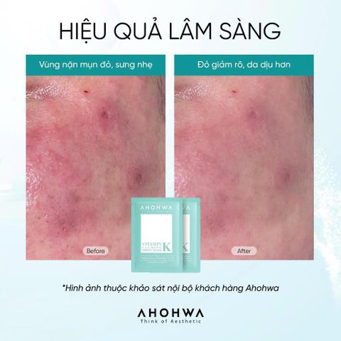 Mặt Nạ Vitamin K Ahohwa - Sheet Mask - Mặt nạ cấp ẩm phục hồi sinh học 