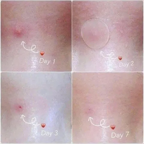 Sales Miếng dán mụn Olive Young Care Plus Spot Patch Mẫu mới cải tiến