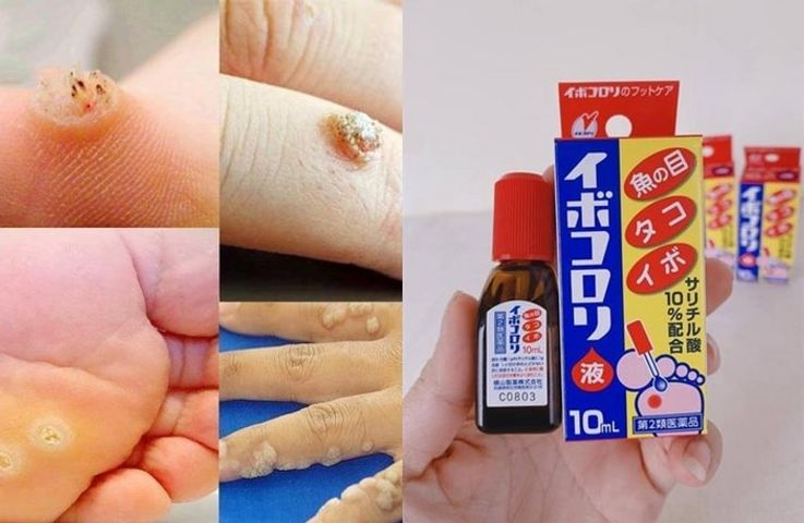 Ibokorori Nhật Hỗ Trợ Giảm Mụn Cóc, Mắt Cá, Chai Sần