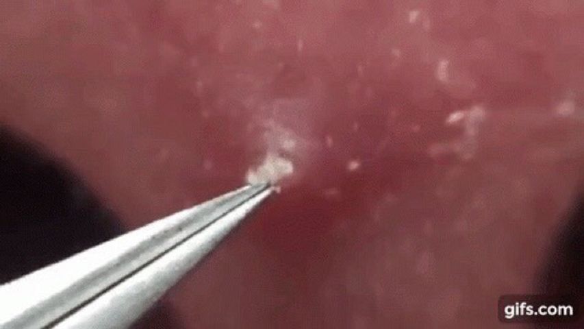 Combo 20 cây Kim Lấy Mụn hỗ trợ lấy mụn