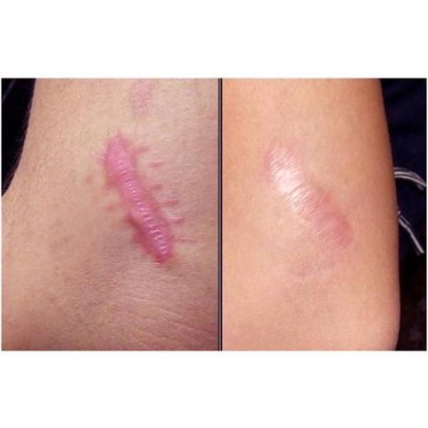 Miếng ép sẹo lồi Hisamitsu Nhật Bản dùng cho sẹo lồi hoặc sẹo mới hình thành