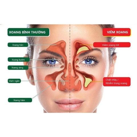 Chai Xịt Mũi Xoang Hỗ Trợ Dứt Điểm Xoang Cấp Và Mãn Tính Nội Địa Trung
