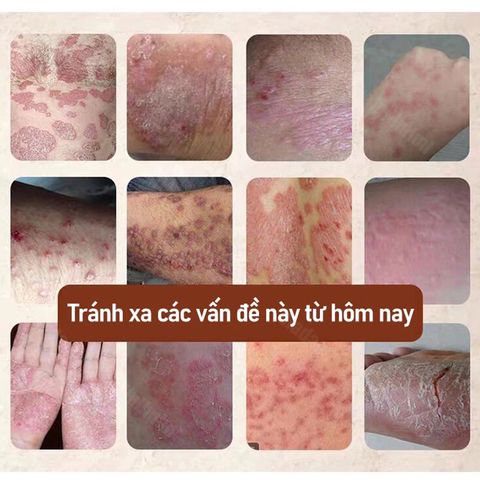 Kem Bôi Da NHẬT BẢN Dứt Điểm Viêm Da Cơ Địa Nấm Ngứa Ghẻ Nước Cực Kì Hiệu Quả