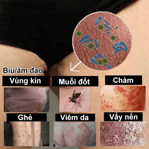 Kem Bôi Da NHẬT BẢN Dứt Điểm Viêm Da Cơ Địa Nấm Ngứa Ghẻ Nước Cực Kì Hiệu Quả