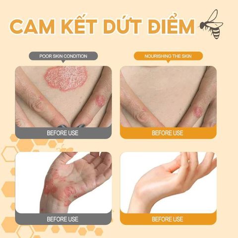 Kem Bôi Da NHẬT BẢN Dứt Điểm Viêm Da Cơ Địa Nấm Ngứa Ghẻ Nước Cực Kì Hiệu Quả