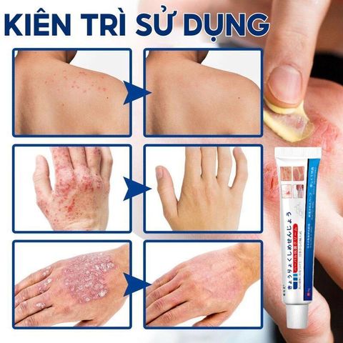 Kem Bôi Da NHẬT BẢN Dứt Điểm Viêm Da Cơ Địa Nấm Ngứa Ghẻ Nước Cực Kì Hiệu Quả