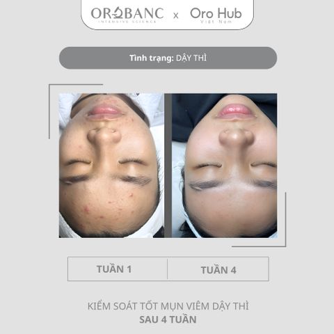 Combo Orobanc Cải Thiện Mụn, Phục Hồi Da Nhạy Cảm - Phyto B3 Acne Ampoule + Ectoin B5 Serum + Cica B3 Cream