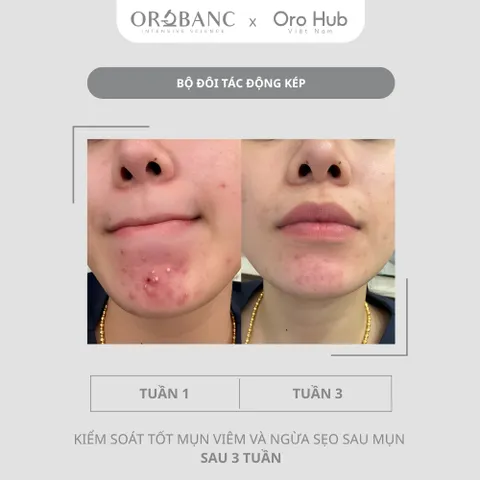 Combo Orobanc Kiểm Soát Mụn, Ngừa Sẹo - Phyto B3 Acne Ampoule + Cica Peptide Serum, Phù Hợp Da Nhạy Cảm