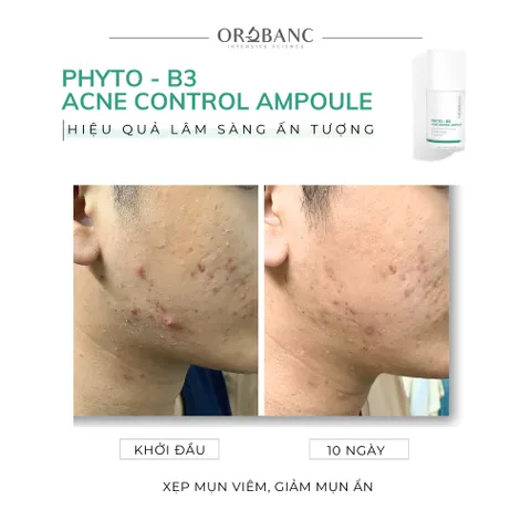 Combo Orobanc Cải Thiện Mụn, Phục Hồi Da Do Cort - Phyto B3 Acne Ampoule 20ml + Cica Peptide Serum 30ml