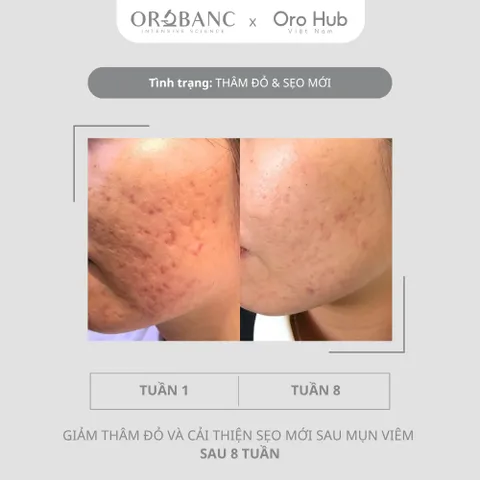 Combo Orobanc Dưỡng Sáng, Mờ Thâm - Cica Peptide Serum 30ml + Asta B3 Serum 30ml