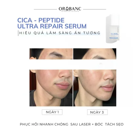 Combo Orobanc Cải Thiện Mụn, Phục Hồi Da Do Cort - Phyto B3 Acne Ampoule 20ml + Cica Peptide Serum 30ml