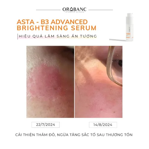 Combo Orobanc Dưỡng Sáng, Mờ Thâm, Ẩm Mịn Phục Hồi Da - Cica Peptide Serum 30ml + Asta B3 Serum 30ml