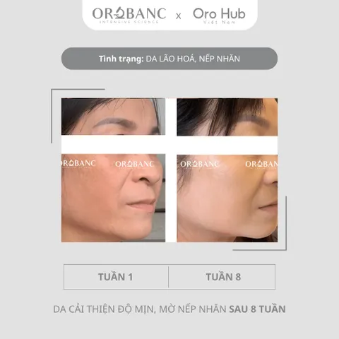 Combo Orobanc Trẻ Hoá Căng Mịn Mờ Nếp Nhăn - Ectoin B5 Serum 30ml - Phyto Retinol Cream 30gr