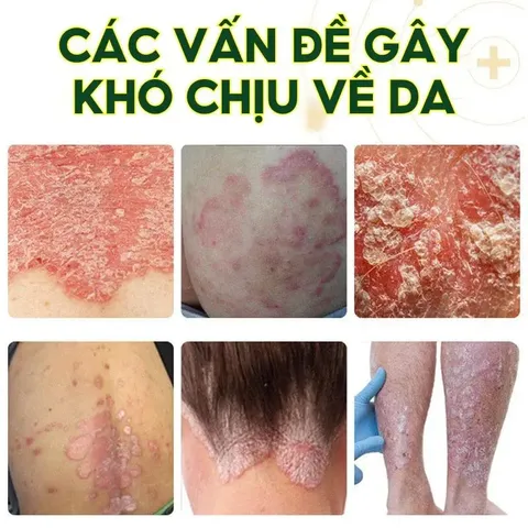 1 Hộp Kem Bôi Nấm Ngứa Viêm Da Cơ Địa NHẬT BẢN Hắc Lào, Tổ Đỉa, Vẩy Nến, Á Sừng, Lang Ben